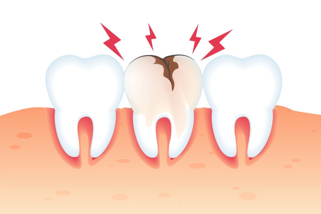 What are Dental Caries?
