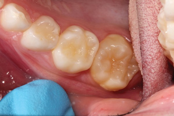 Dental Restoration in Kid