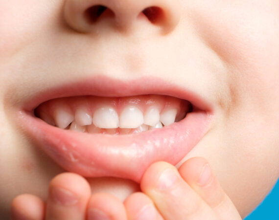 Pediatric / Child Dentistry @ Max Face Aesthetics
