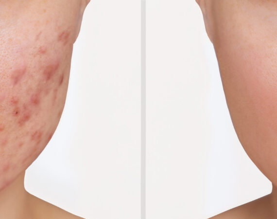 Acne Scar Removal @Max Face Aesthetics