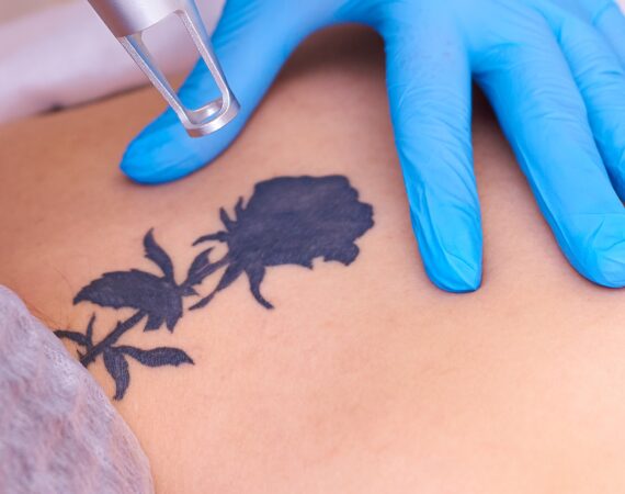 Permanent Tattoo Removal in Secunderabad using Laser