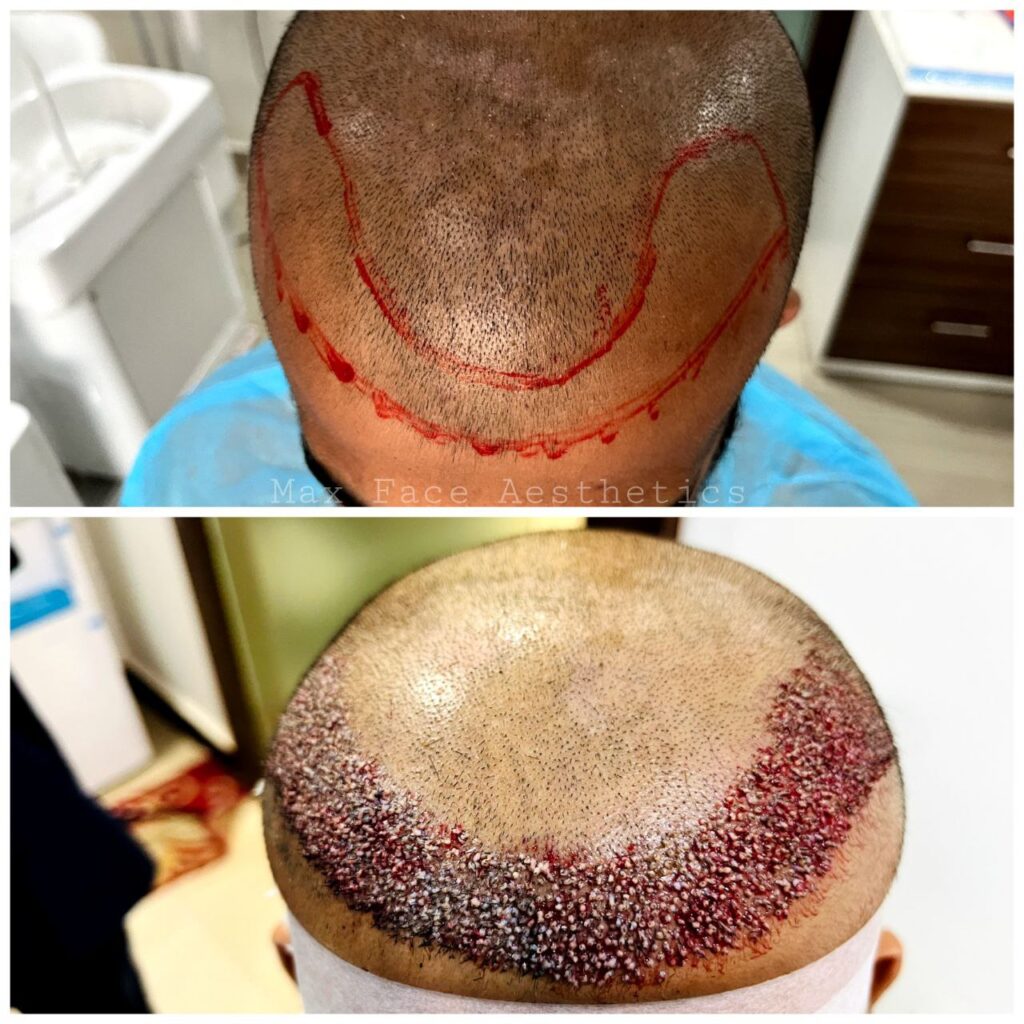 Hair Transplant by Dr B Ashwin Rao, Secunderabad