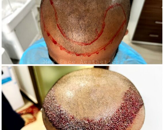 Hair Transplant by Dr B Ashwin Rao, Secunderabad